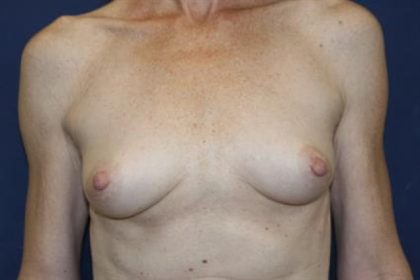 Breast Augmentation Before & After Patient #2241