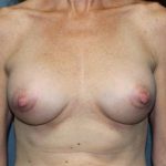 Breast Augmentation Before & After Patient #2241