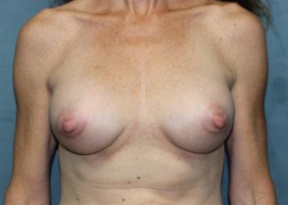 Breast Augmentation Before & After Patient #2241