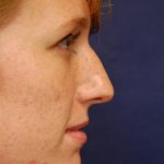 Rhinoplasty Before & After Patient #1658