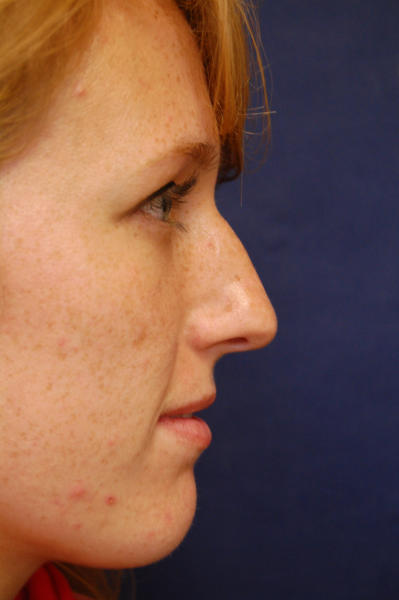 Rhinoplasty Before & After Patient #1658