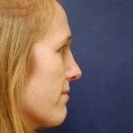 Rhinoplasty Before & After Patient #1658