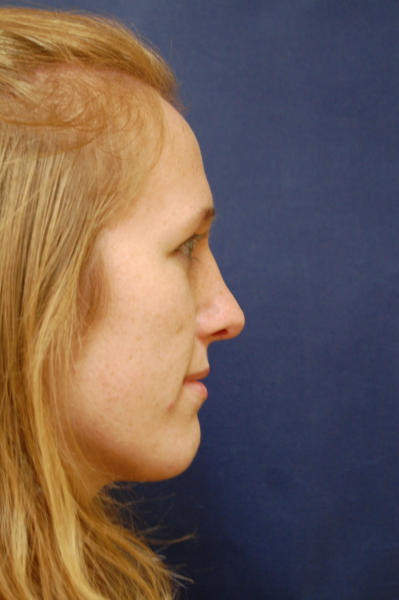 Rhinoplasty Before & After Patient #1658