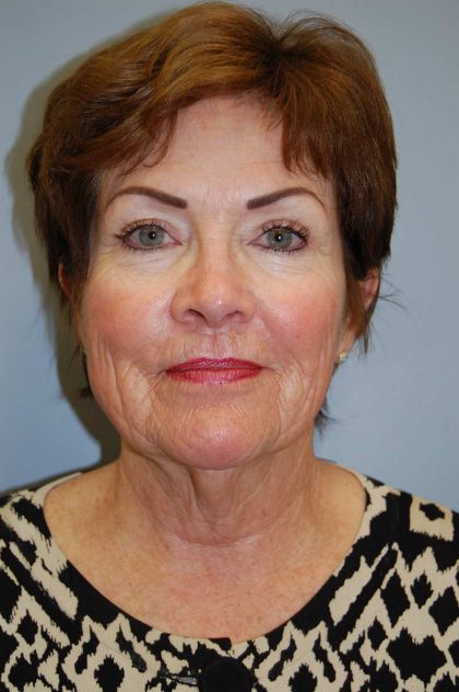 Facelift Before & After Patient #580