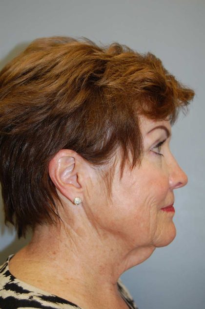 Facelift Before & After Patient #580