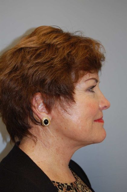 Facelift Before & After Patient #580