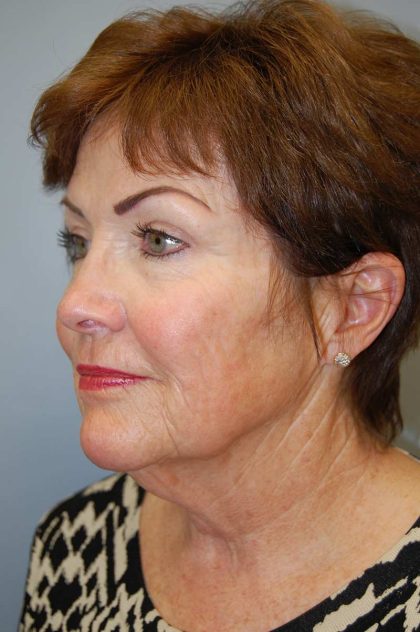 Facelift Before & After Patient #580