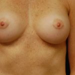 Breast Augmentation Before & After Patient #2195