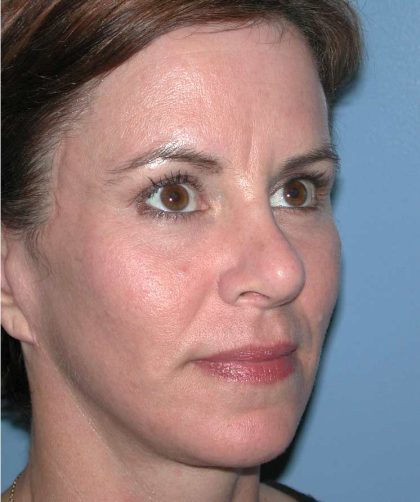 Facelift Before & After Patient #2781