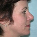 Facelift Before & After Patient #2781