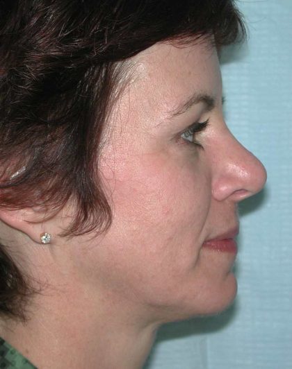 Facelift Before & After Patient #2781