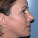 Facelift Before & After Patient #2781