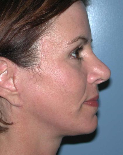 Facelift Before & After Patient #2781