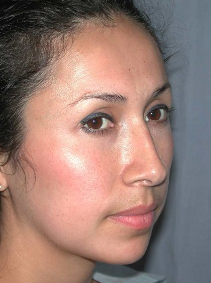 Ethnic Rhinoplasty Before & After Patient #1316