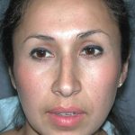 Ethnic Rhinoplasty Before & After Patient #1316