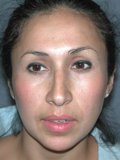 Ethnic Rhinoplasty Before & After Patient #1316