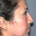 Ethnic Rhinoplasty Before & After Patient #1316