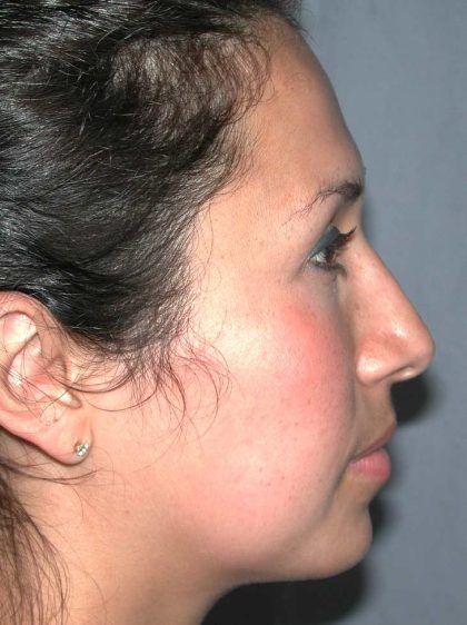 Ethnic Rhinoplasty Before & After Patient #1316