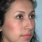 Ethnic Rhinoplasty Before & After Patient #1316