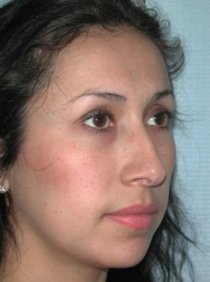 Ethnic Rhinoplasty Before & After Patient #1316