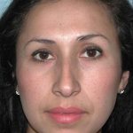 Ethnic Rhinoplasty Before & After Patient #1316