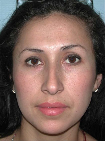 Ethnic Rhinoplasty Before & After Patient #1316