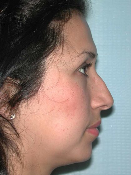 Ethnic Rhinoplasty Before & After Patient #1316