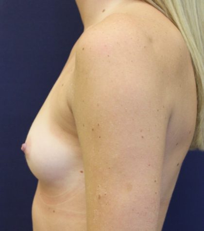 Breast Augmentation Before & After Patient #2454