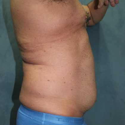 Liposuction Before & After Patient #1808