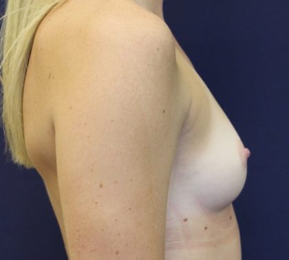 Breast Augmentation Before & After Patient #2454