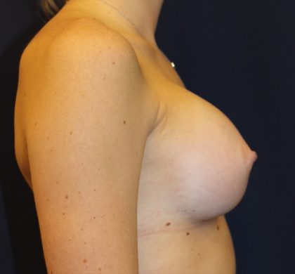 Breast Augmentation Before & After Patient #2454