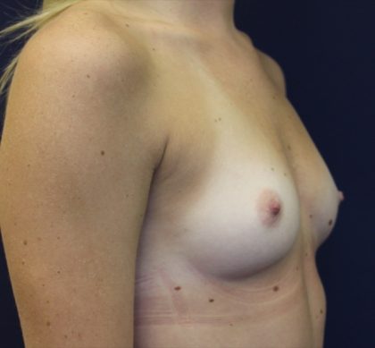 Breast Augmentation Before & After Patient #2454