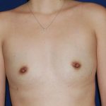 Breast Augmentation Before & After Patient #2402