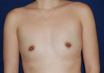 Breast Augmentation Before & After Patient #2402