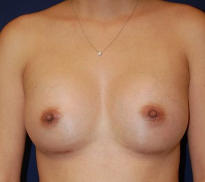 Breast Augmentation Before & After Patient #2402