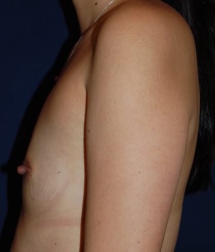 Breast Augmentation Before & After Patient #2402