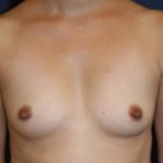 Breast Augmentation Before & After Patient #2390