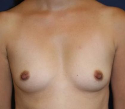 Breast Augmentation Before & After Patient #2390