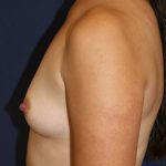 Breast Augmentation Before & After Patient #2506
