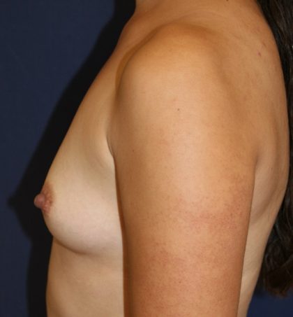 Breast Augmentation Before & After Patient #2506