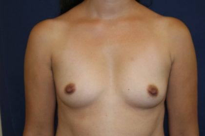 Breast Augmentation Before & After Patient #2506