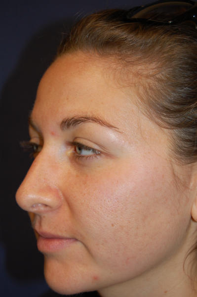 Rhinoplasty Before & After Patient #1664