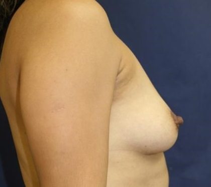 Breast Augmentation Before & After Patient #2451