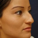 Rhinoplasty Before & After Patient #1699