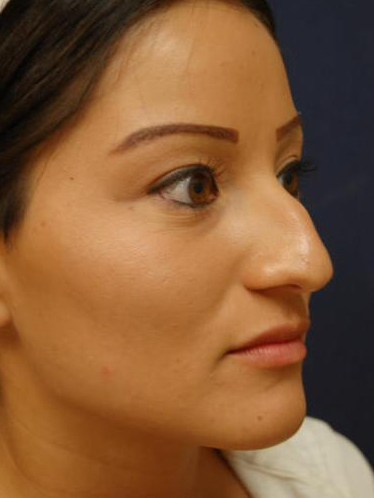 Rhinoplasty Before & After Patient #1699