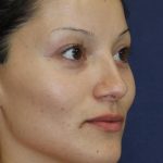 Rhinoplasty Before & After Patient #1699