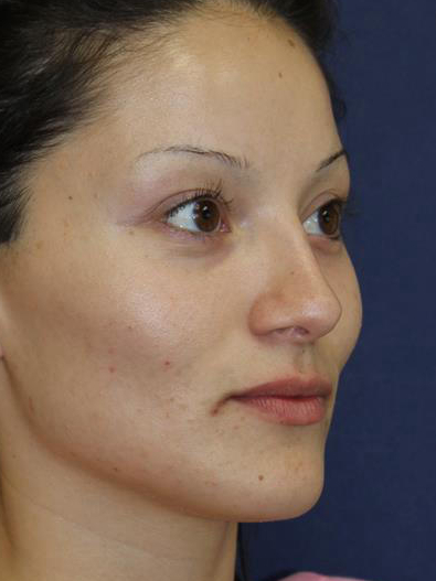 Rhinoplasty Before & After Patient #1699