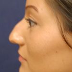 Rhinoplasty Before & After Patient #1699