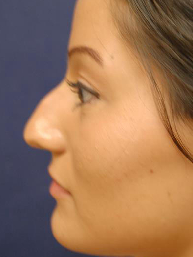 Rhinoplasty Before & After Patient #1699