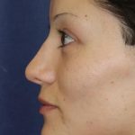 Rhinoplasty Before & After Patient #1699